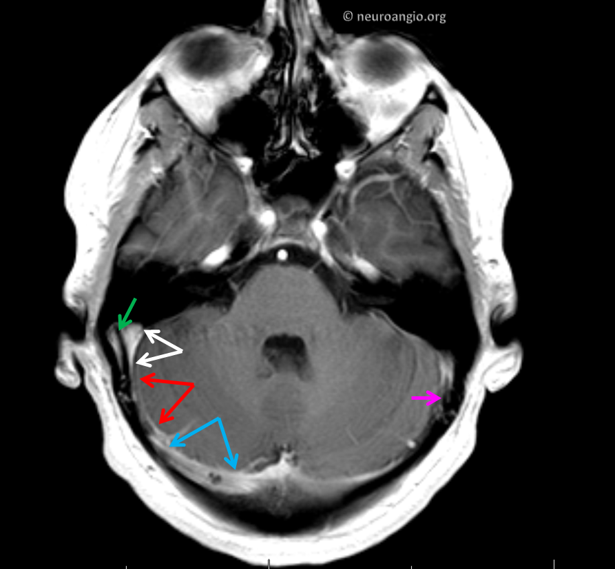 Tinnitus of hot sale right ear